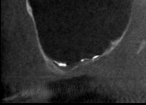 ay DVT görüntüsü TARTIŞMA Maksiller sinüs mukoseli genellikle nadir görülen, yavaş büyüyen ve klinik olarak iyi huylu gelişim gösteren bir patolojidir.