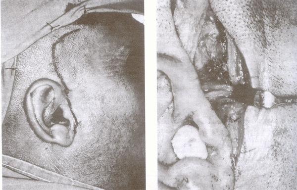 diseksiyonla kondil boynu tespit edildi (Resim 4).