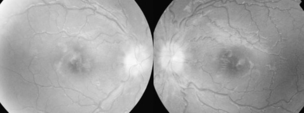 nöropati inflamatuar, iskemik, demiyelinizan ve enfeksiyöz nedenlerle optik sinirin etkilenmesine bağlı görme keskinliği ve görme alanı kaybı ile sonuçlanabilen optik sinir hastalığıdır.