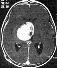 Resim 1. Optik gliom nedeniyle opere edilen hastan n transvers düzlemde kontrast sonras MTK T1 SE (), fast FLIR () ve kontrastl fast FLIR (C) MRG görüntüleri.