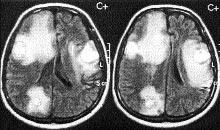 eyin parenkiminde T1 görüntülerde MTK sekans ile genel bir bask lanma gerçekleştiği halde, yağ ve serebrospinal s v bundan etkilenmez.