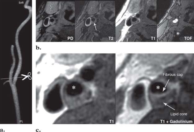 Plak karekterizasyonunda kontrast kullanımı PET-CT İleri karotis