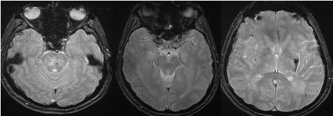 Hücreli arterit Takayasu Arteriti BEHÇET Hastalığı    polianjiitis Wegener Granulomatosis Churg Strauss