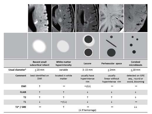 STRIVE Küçük Damar Hastalığı Alt Tipler: MRI Özellikleri MRG de Ak Madde Lezyonları Derecelendirilmesi Fazekas 0: Lezyon yok ya da tek noktasal lezyon (Ak