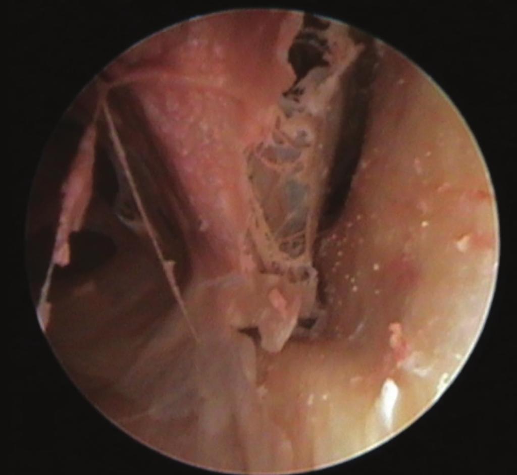 00 teleskopla, sağ taraftan, trigeminal sinirin motor ve duysal köklerinin ayrımının yapıldığı görüntü (a), 30 teleskopla, sol taraftan, trigeminal sinirin motor ve duysal köklerinin ayrımının