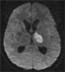 endokarditi (nonbakteriyel trombotik endocardit), SLE