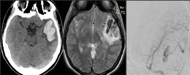 nöbet geçirme akut transvers sinüs trombüsü Sinovenöz trombüs Çocuklukta