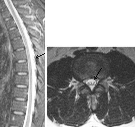 ağrısı iki gün içinde düzelen olgunun işlemden iki gün sonra anal bölgede hipoestezi, idrarını ve gaita yapamama yakınması oldu. Tekrarlayan beyin MRG ve venografi normal olarak değerlendirildi.