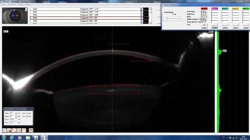 Şekil 1 Anterior alanın lens densitometre ile 3 boyutlu ölçümü.