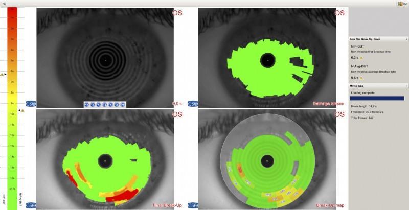 Şekil 1 Scheimpflug görüntüleme sistemi ile non-invazif olarak başlangıç ve ortalama gözyaşı kırılma