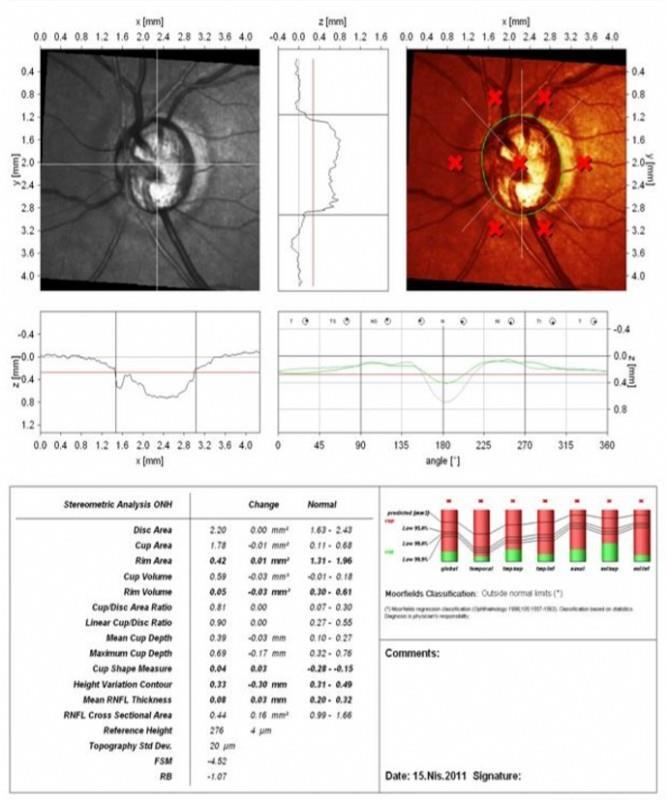 Resim 3 Aynı hastanın Heidelberg retinal tomografi (HRT