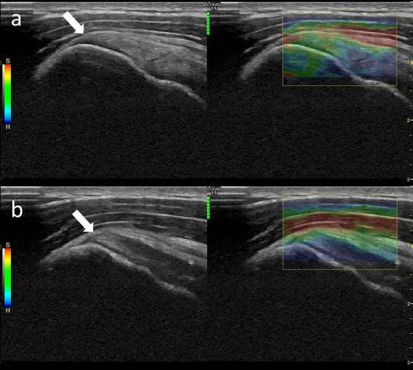 Resimler : Resim Açıklaması: a) 19 yaşında erkek normal supraspinatus tendon gri skala ultrason ve strain elastografik görüntüleri,