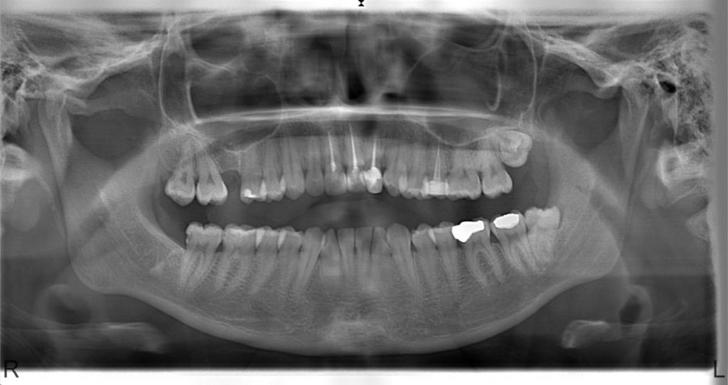 Üç ay önce dış merkezde hastanın sağ üst birinci molar ve ikinci molar dişlerine endodontik tedavi yapıldığı öğrenildi.