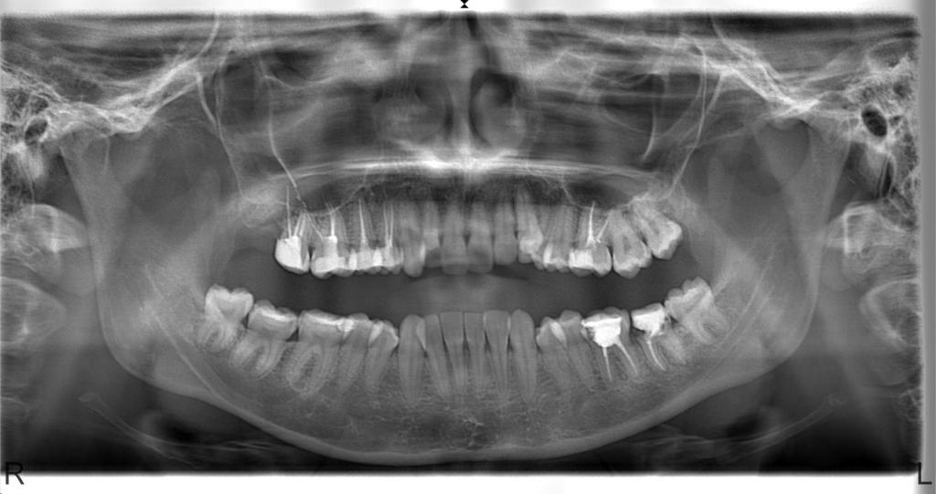 Şekil 4 : Sağ üst molar dişlerde gözlenen taşkın kanal dolumları ve sinüs içerisindeki kanal dolgu materyalleri Şekil 5 :