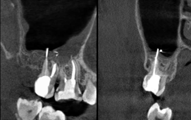 Sulkuler insizyonun devamında rond frez ile maksiller sinüsün lateral duvarından bir pencere açılarak sağ üst birinci molar ve