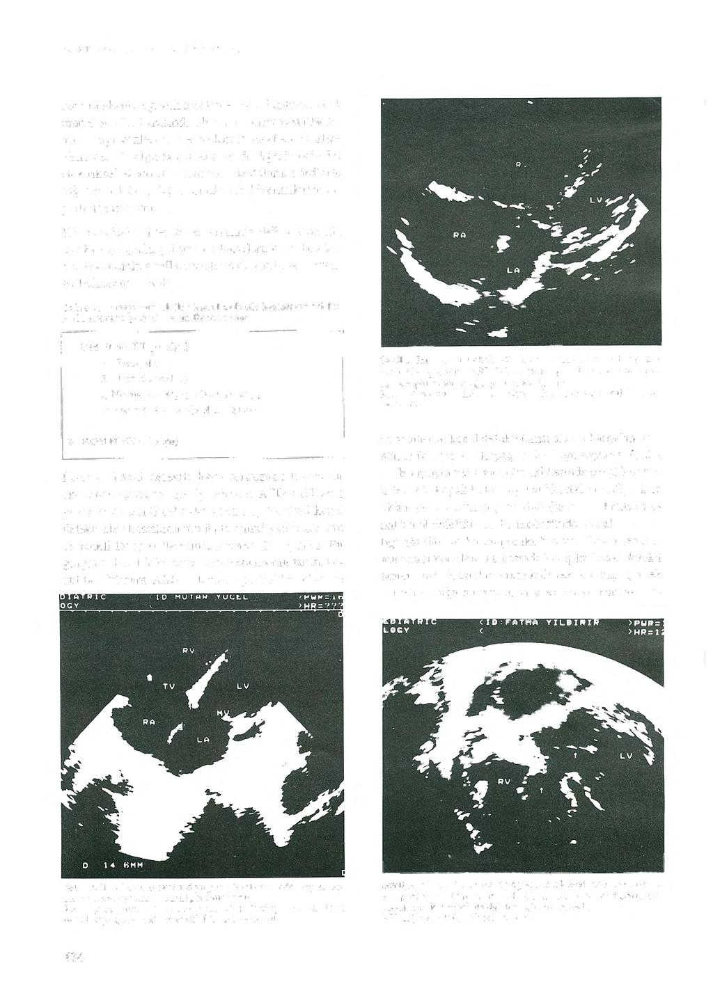 Tiirk Kardiyol Dern Arş 1996; 24: 433-437 ların telekardiyografik incelemesinde, kardiyetorasik oran 0,56-0.70 arasında olup, pulmoner vaskülaritenin arttığ ı gözlendi.