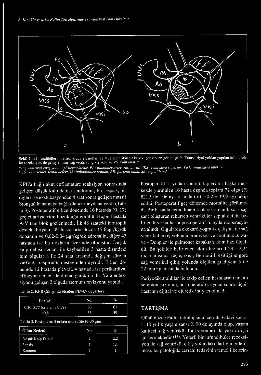 PA: pulmoner arter, Ao: aoı ta, VKS: ve11a kaı a superior, V Ki : ı eıwl kava i11jerior VSD: vemrikıller septal defekt, IS: iııfw ıdihiiler septtmı, P.