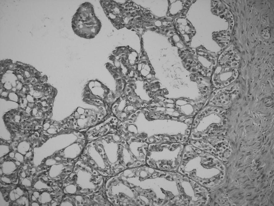 Sol ovaryum biyopsisinin histopatolojik incelemesinde sa ovaryumdakine benzer seröz epitel ile döfleli nonneoplastik görünümlü çok say da seröz kistik yap, mikroskopik bir odakta fibrovasküler sap