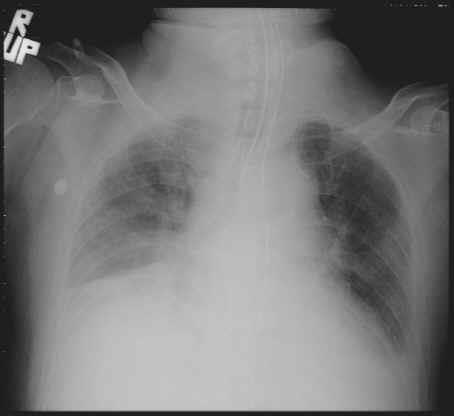 Asit-baz Asit-bazdengesi Kimyasal tamponlar (çok hızlı) Bikarbonat Hb Fosfat Protein Solunumsal kompanzasyon -CO 2 in eksalasyonu ile