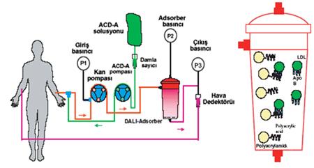 Poliakrilat Kaplı Poliakrilamid Direkt Perfüzyonu (DALI) Diğer sistemlerin aksine ilk kez tam kandan LDL adsorbsiyonu İlk kez 1997 yılında DALI sistemi, LDL-K ve Lp(a) yı kolonda tutmak
