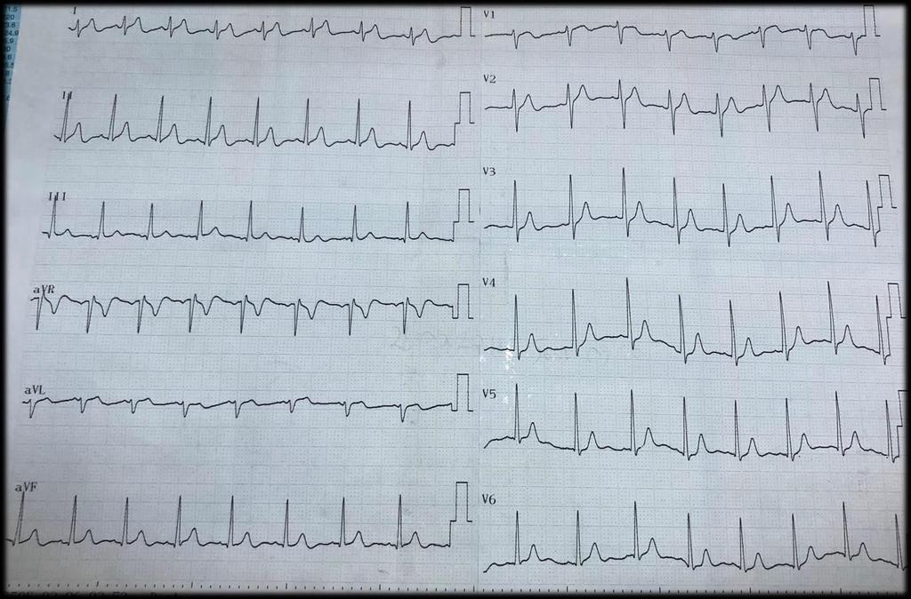 EKG