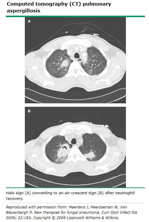 İnvaziv Pulmoner Aspergillozisde radyolojik tanı, İPA için klinik şüphesi durumunda akciğer grafisi yanında CT CT da rutin kontrast
