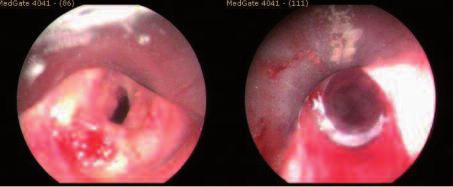 RESİM 7: Postentübasyon trakeal darlık stenotik silikon stent ile giderilmiştir (Yedikule arşivi). sında esas amaç, nesnenin daha da ileriye kaçmasını engellemektir.