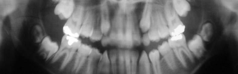 Arslan, Devecio lu-kama, K l ç Resim 2: Tedavi öncesi panoramik görüntüsü Figure 2: Pre-treatment panoramic radiograph ci molarlar n durumunun kötü olmas nedeniyle mevcut astada üçüncü yöntem tercih