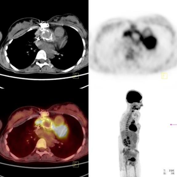 6 Kasım 2015/ PET-BT Görüntüleri Sternum korpusunda BT de destrüksiyonun eşlik ettiği fokal hipermetabolizma (osteomiyelit)