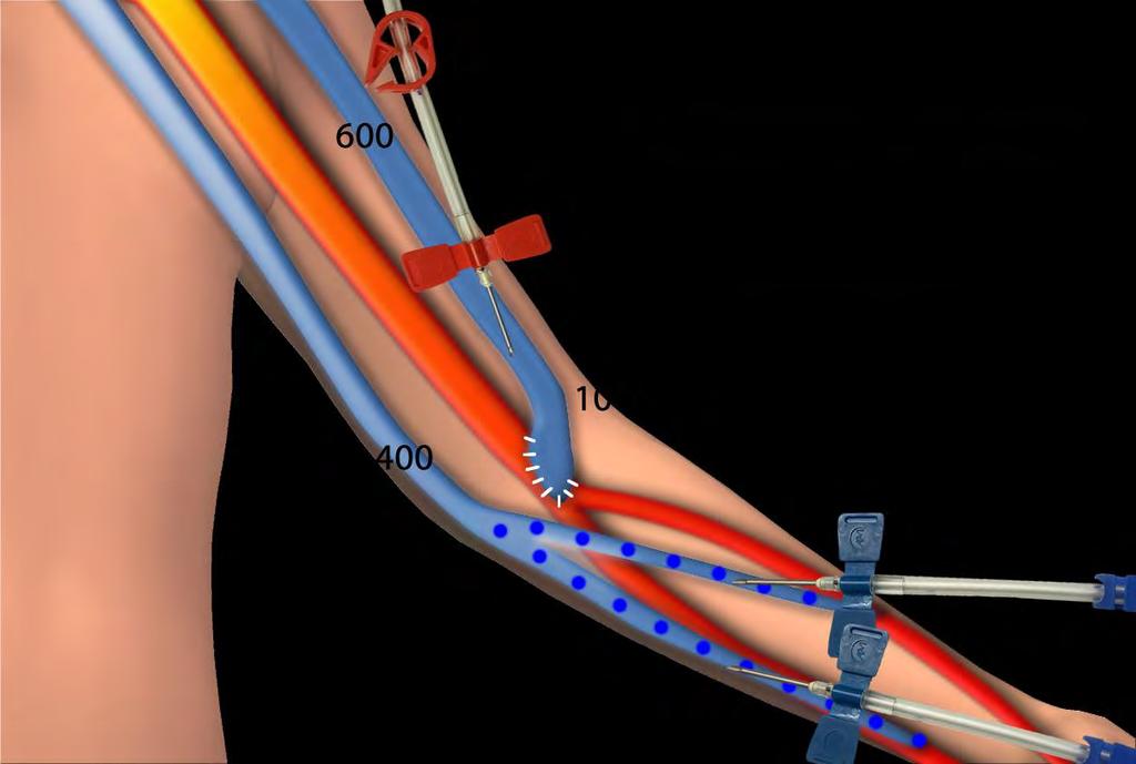 VEN İĞNESİNİN ARTERİN DAHA DİSTALİNDEN UYGULANMASI