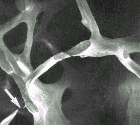 kırık riskinde artış Osteoporotik kemik