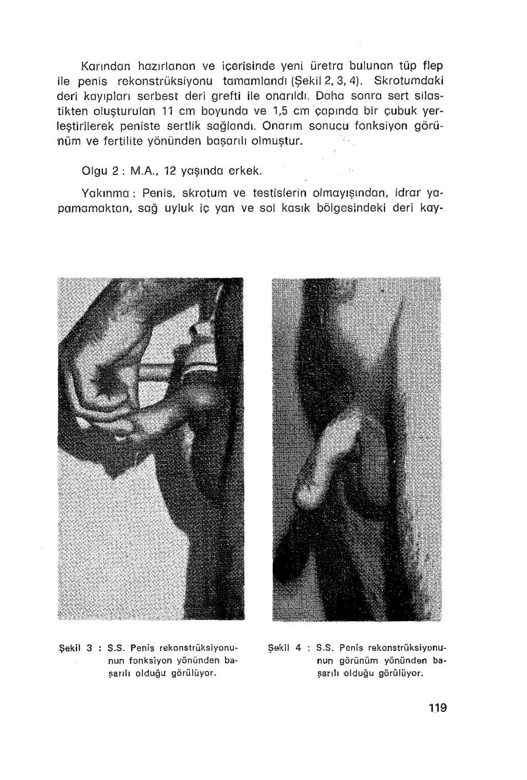 Karından hazırlanan ve içerisinde yeni üretra bulunan tüp flep ile penis rekonstrüksiyonu tamamlandı (Şekil 2, 3, 4).