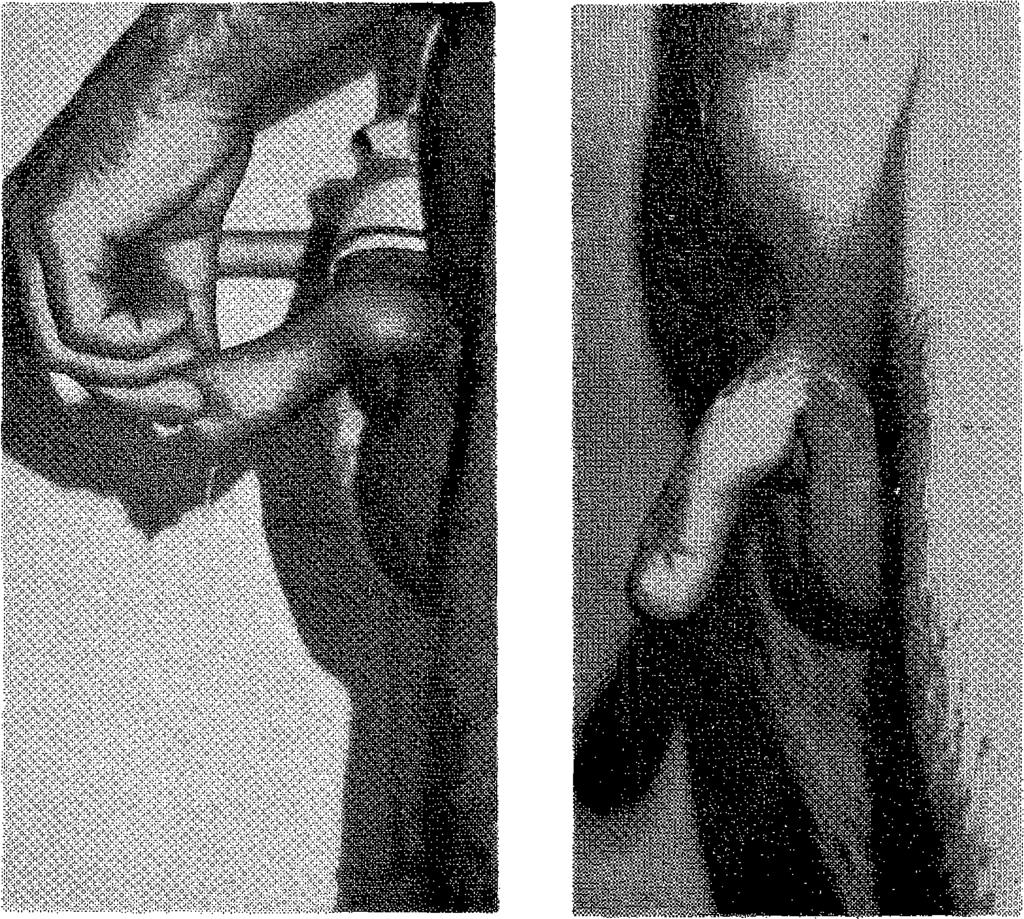 sağlandı. Onarım sonucu fonksiyon görünüm ve fertiliîe yönünden başarılı olmuştur. Olgu 2 : M.A., 12 yaşında erkek.