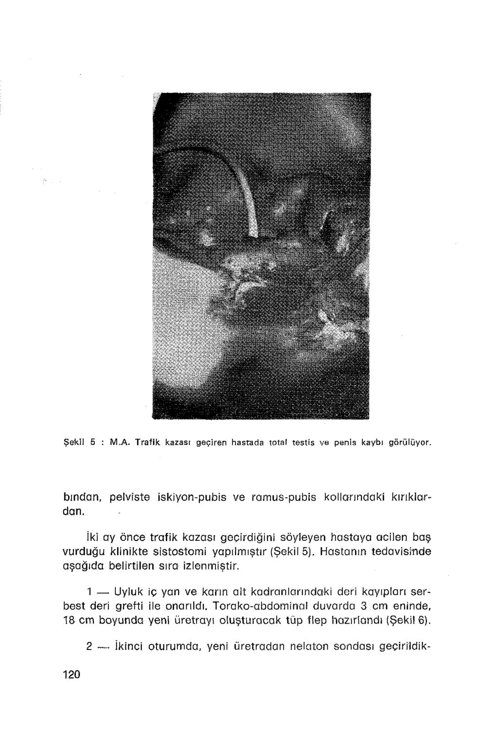 Şekil 5 : M.A. Trafik kazası geçiren hastada total testis ve penis kaybı görülüyor. bından, pelviste iskiyon-pubis ve ramus-pubis kollarındaki kırıklardan.