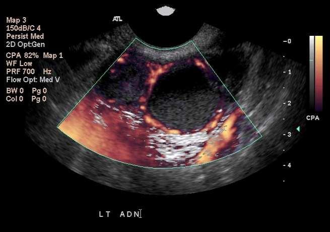 Endometriosisli Olgularda IVF de Komplikasyon Özellikle ovaryan endometriomalı olgularda over apsesi