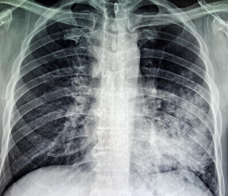 OLGU-Ocak 2014 TORAKS CT: Sol akciğer lingular alanda konsolide alan saptandı.