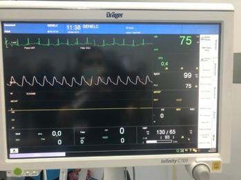 Olgu İNDüKSİYON Deksametazon 8mg