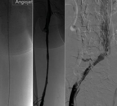 Hasta ülseratif kolitten gastrointestinal kanama nedeniyle trombolitik tedavi alamamıştır. Şekil 4. 20 mm'lik bir Wallstent'in (Boston Scientific) yerleştirilmesi (A).