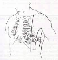 ekil 5. Gö üs derivasyonları için elektrodların yerle im yerleri Kalp uyarımının kalpte ilerlemesi esnasında elektriksel akım kalbi çevreleyen kom u dokulara da yayılır.