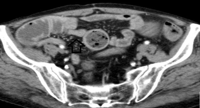 Şekil 1C : Bilgisayarlı tomografi görüntüsü Laparotomik eksplorasyonda ince bağırsak