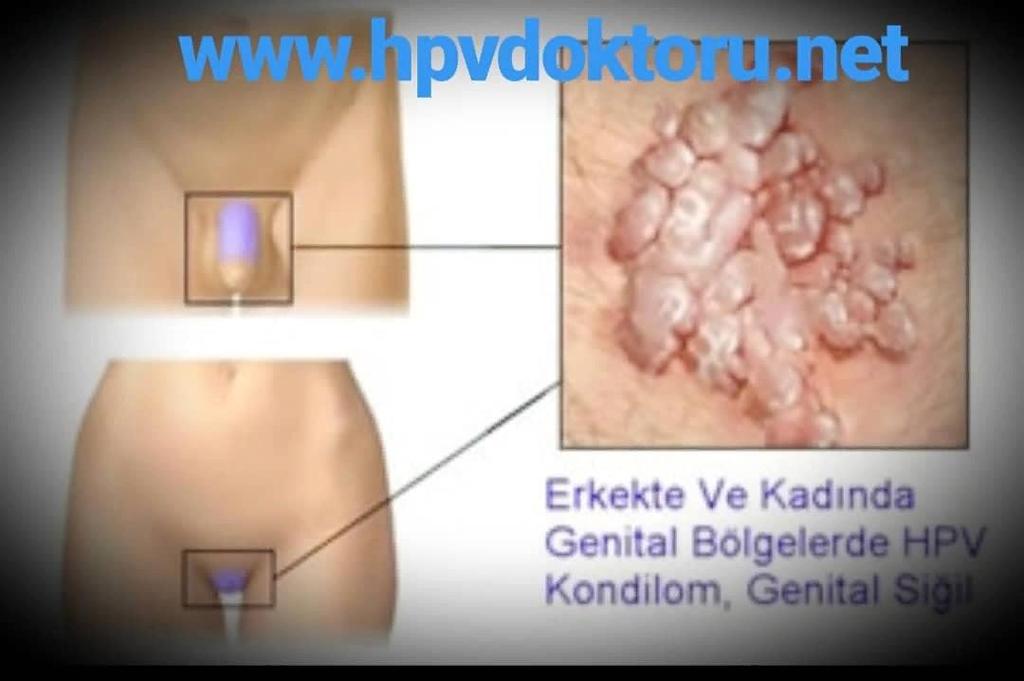 Serviks kanseri ; Serviks uterusun vajinal ağzıdır ve rahim ağzı kanseri de denir. En büyük nedeni HPV virüsüdür. Ayrıca kötü hijyen koşulları, çok sayıda-zor doğumlar da neden olabilir.