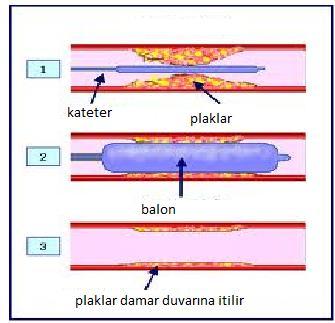 Balon işlemi 6 www.