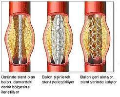 Şekil 2: Stent