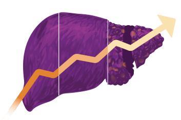 Siroz AST > ALT Trombosit sayısında kademeli düşüş Globulinlerde artış Protein elektroforezinde poliklonal