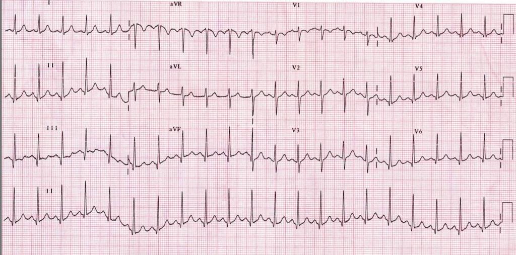 Düzenli dar QRS kompleksi taşikardi 100-180 atım/dk P dalgaları normal Her QRS öncesi P dalgası