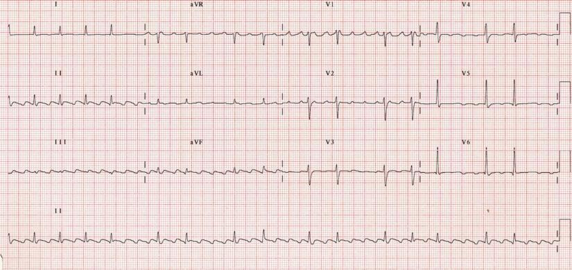 EKG Testere dişi şeklinde P dalgaları ile karakterize Flutter dalgaları en iyi D2, D3 ve avf da görülür Değişken AV blok
