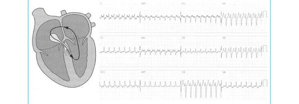 Ortodromik Dar QRS taşikardi Ortodromik ileti