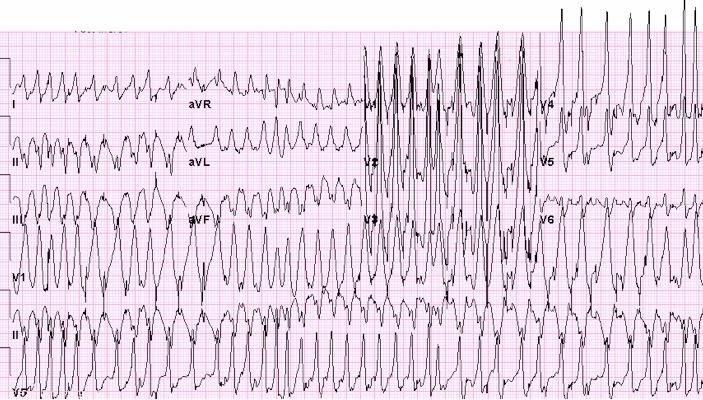 Geniş QRS kompleksli irregüler bir taşikardi LBBB+AF, Polimorfik VT, TdP, WPW+ AF hangisi