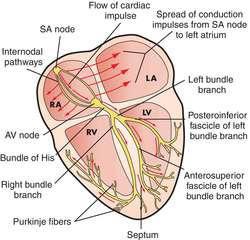 Ventriküler preeksitasyon Kalp ileti sisteminde normal ileti SA noddan