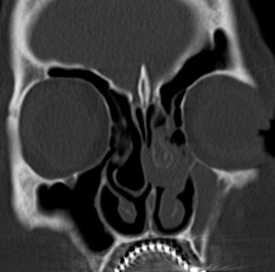Şekil 2 : Paranazal sinüs bilgisayarlı tomografi koronal kesitte her iki konkanın pnömatize olduğu ve sol orta konkada heterojen yumuşak doku dansitesinde artış görülüyor Hastanın Nöroloji